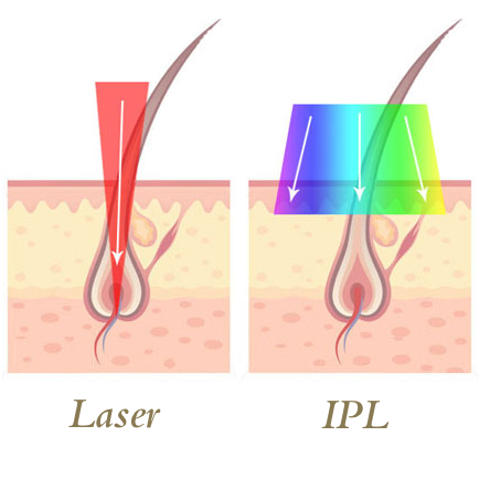 IPL versus Laser Hair Removal