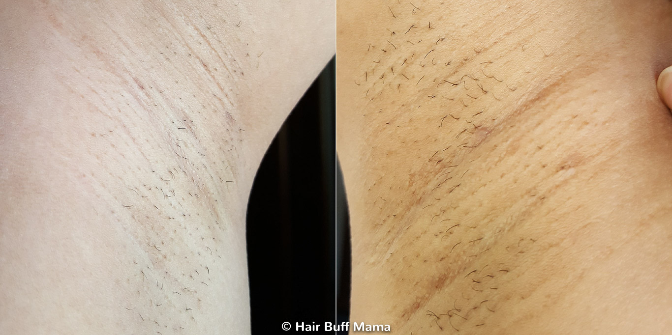 Remington iLight Before and After Photo (2nd Treatment)