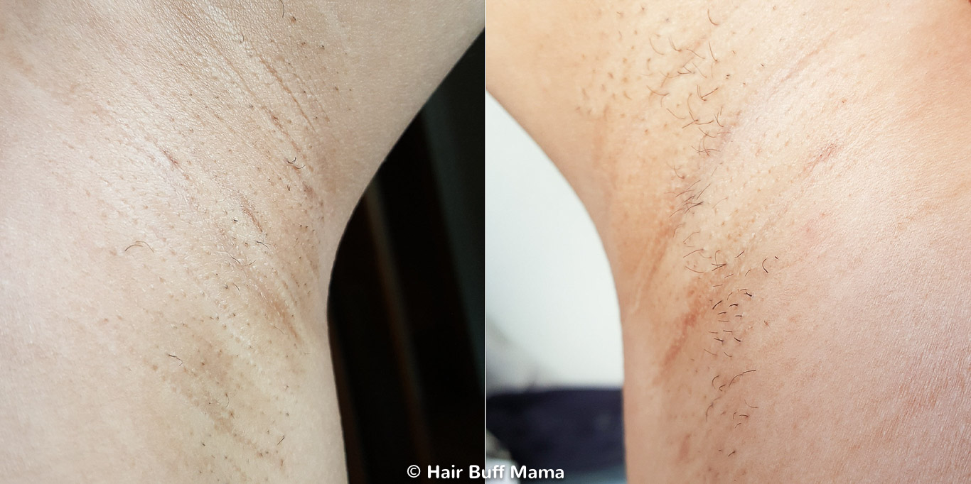 Remington iLight Before and After Photo (4th Treatment)