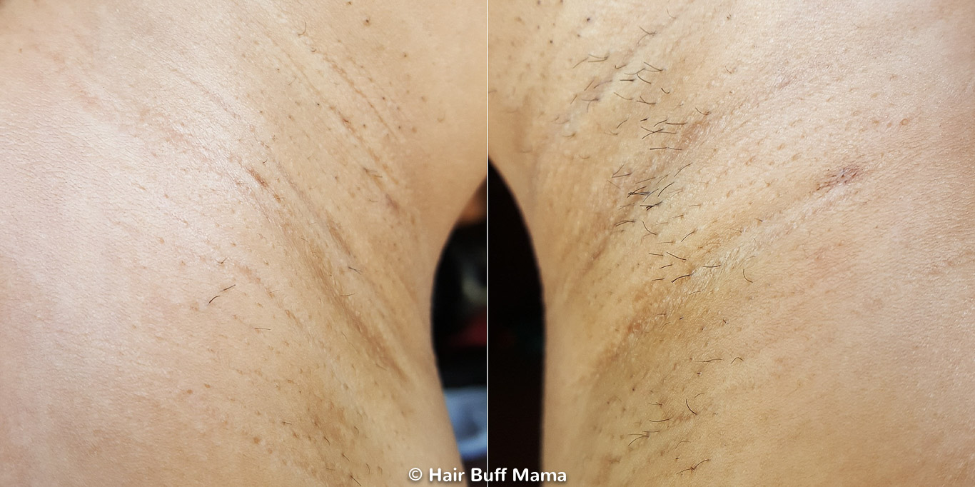 Remington iLight Before and After Photo (5th Treatment)