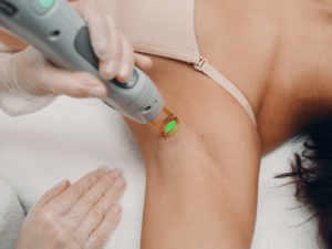 picture of lady getting laser treatment on armpit hair. 