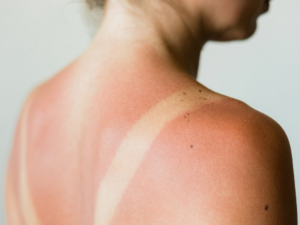 The sun can be highly damaging to the skin even without laser hair removal. This photo demonstrates the effects of sun damage to skin without laser hair removal.